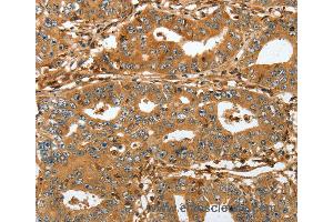 Immunohistochemistry of Human lung cancer using RAP1A Polyclonal Antibody at dilution of 1:45 (RAP1A Antikörper)