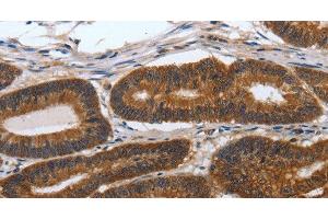 Immunohistochemistry of paraffin-embedded Human colon cancer tissue using PDCD7 Polyclonal Antibody at dilution 1:60 (PDCD7 Antikörper)