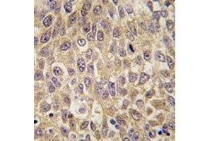 IHC analysis of FFPE human hepatocarcinoma tissue stained with AFP antibody