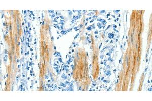 Immunohistochemistry of paraffin-embedded Human gastic cancer using CAV3 Polyclonal Antibody at dilution of 1:30 (Caveolin 3 Antikörper)