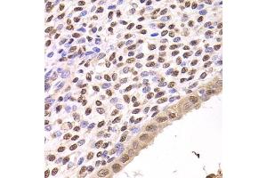 Immunohistochemistry of paraffin-embedded human adenomyosis using FKBP4 Antibody (ABIN5973289) at dilution of 1/200 (40x lens). (FKBP4 Antikörper)