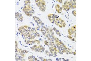Immunohistochemistry of paraffin-embedded human breast cancer using RFC4 Antibody (ABIN5973195) at dilution of 1/100 (40x lens). (RFC4 Antikörper)