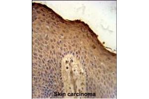 ISM1 Antibody (C-term) (ABIN651237 and ABIN2840147) immunohistochemistry analysis in formalin fixed and paraffin embedded human skin carcinoma followed by peroxidase conjugation of the secondary antibody and DAB staining. (ISM1 Antikörper  (AA 435-464))