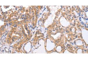 Immunohistochemistry of paraffin-embedded Human thyroid cancer tissue using TGFA Polyclonal Antibody at dilution 1:60 (TGFA Antikörper)