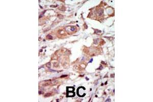 Formalin-fixed and paraffin-embedded human cancer tissue reacted with the MAP3K10 polyclonal antibody  , which was peroxidase-conjugated to the secondary antibody, followed by DAB staining. (MAP3K10 Antikörper  (C-Term))