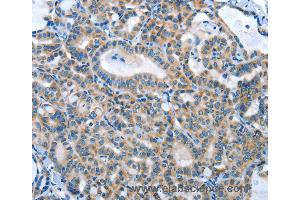 Immunohistochemistry of Human thyroid cancer using ANGPT2 Polyclonal Antibody at dilution of 1:45 (Angiopoietin 2 Antikörper)