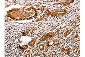 The image on the left is immunohistochemistry of paraffin-embedded Human gastric cancer tissue using ABIN7130598(PGC Antibody) at dilution 1/25, on the right is treated with fusion protein. (PGC Antikörper)