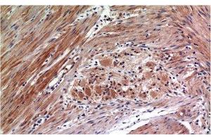 Immunohistochemistry of paraffin-embedded Human colon carcinoma tissue with Phospho-ERK 1/2 (Tyr222/205) Monoclonal Antibody at dilution of 1:200 (ERK1/2 Antikörper  (pTyr205, pTyr222))