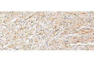 Immunohistochemistry of paraffin-embedded Human liver cancer tissue using EPRS Polyclonal Antibody at dilution of 1:60(x200) (EPRS Antikörper)