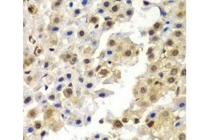 Immunohistochemistry of paraffin-embedded Human liver cancer using SYNCRIP Polyclonal Antibody at dilution of 1:100 (40x lens). (SYNCRIP Antikörper)