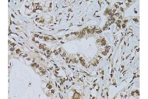 Immunohistochemistry of paraffin-embedded human gastric cancer using EMD antibody. (Emerin Antikörper  (AA 1-220))