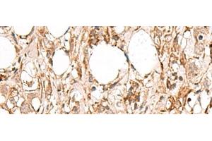 Immunohistochemistry of paraffin-embedded Human breast cancer tissue using FBXW8 Polyclonal Antibody at dilution of 1:65(x200) (FBXW8 Antikörper)