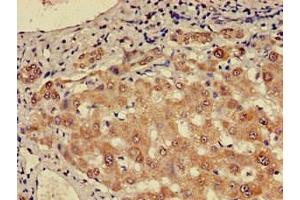 Immunohistochemistry of paraffin-embedded human liver cancer using ABIN7147724 at dilution of 1:100 (CHD5 Antikörper  (AA 1600-1699))