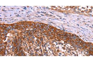 Immunohistochemistry of paraffin-embedded Human cervical cancer using ABI1 Polyclonal Antibody at dilution of 1:40 (ABI1 Antikörper)