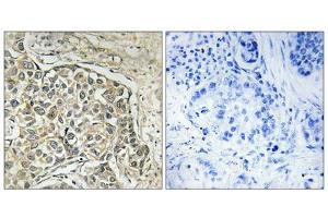 Immunohistochemistry analysis of paraffin-embedded human lung carcinoma tissue using ARSD antibody. (Arylsulfatase D Antikörper  (Internal Region))