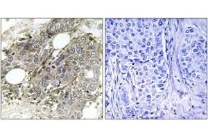 Immunohistochemistry analysis of paraffin-embedded human breast carcinoma tissue, using TGF beta Receptor III (Ab-842) Antibody. (TGFBR3 Antikörper)