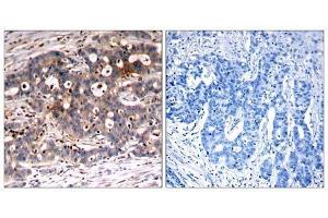 Immunohistochemical analysis of paraffin-embedded human breast carcinoma tissue, using Shc1 (Ab-427) antibody (E021317). (SHC1 Antikörper)