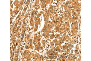 Immunohistochemistry of Human esophagus cancer using DIRAS1 Polyclonal Antibody at dilution of 1:52