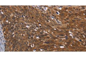 Immunohistochemistry of paraffin-embedded Human cervical cancer using FHIT Polyclonal Antibody at dilution of 1:30 (FHIT Antikörper)