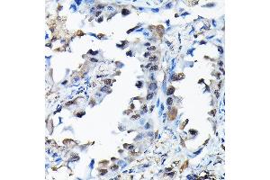 Immunohistochemistry of paraffin-embedded human lung cancer using RBBP9 Rabbit pAb (ABIN6129095, ABIN6146752, ABIN6146753 and ABIN6220638) at dilution of 1:200 (40x lens). (RBBP9 Antikörper  (AA 1-186))