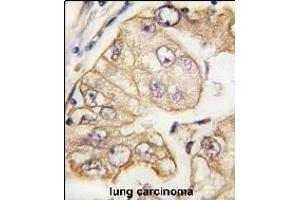 Formalin-fixed and paraffin-embedded human lung carcinoma tissue reacted with VGFR3 Monoclonal Antibody (ABIN387818 and ABIN2843906) , which was peroxidase-conjugated to the secondary antibody, followed by DAB staining. (FLT4 Antikörper)