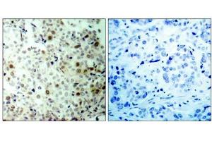 Immunohistochemical analysis of paraffin- embedded human breast carcinoma tissue, using CDK2 (phospho-Thr160) antibody (E011133). (CDK2 Antikörper  (pThr160))