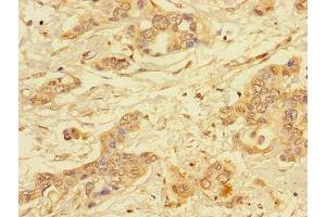 Immunohistochemistry of paraffin-embedded human pancreatic cancer using ABIN7143770 at dilution of 1:100 (ALG2 Antikörper  (AA 303-405))