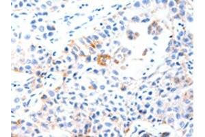 The image on the left is immunohistochemistry of paraffin-embedded Human lung cancer tissue using ABIN7191546(MUC3A Antibody) at dilution 1/60, on the right is treated with synthetic peptide. (MUC3A Antikörper)