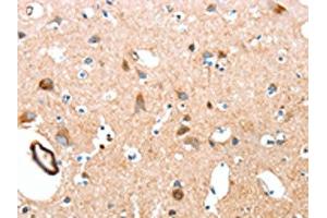 The image on the left is immunohistochemistry of paraffin-embedded Human brain tissue using ABIN7189570(AARS Antibody) at dilution 1/50, on the right is treated with synthetic peptide. (AARS Antikörper)