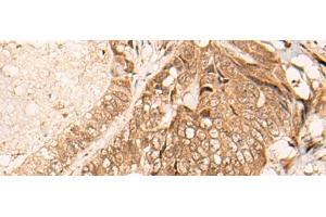Immunohistochemistry of paraffin-embedded Human colorectal cancer tissue using HIPK3 Polyclonal Antibody at dilution of 1:60(x200) (HIPK3 Antikörper)