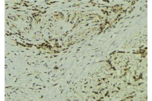 ABIN6273106 at 1/100 staining Human breast cancer tissue by IHC-P. (SS18L1 Antikörper)