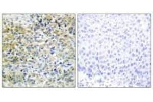 Immunohistochemistry analysis of paraffin-embedded human liver carcinoma tissue using CARKL antibody. (SHPK Antikörper  (N-Term))