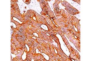IHC staining of colon carcinoma with pan Cytokeratin antibody cocktail AE1 + AE3. (pan Keratin Antikörper)