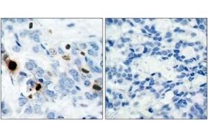 Immunohistochemistry analysis of paraffin-embedded human breast carcinoma, using Histone H3. (Histone H3.1 Antikörper  (pSer10))