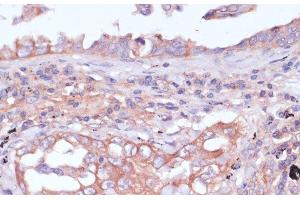 Immunohistochemistry of paraffin-embedded Human lung cancer using RPL32 Polyclonal Antibody at dilution of 1:100 (40x lens). (RPL32 Antikörper)
