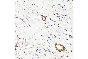 Immunohistochemistry of paraffin-embedded human prostate cancer using VASH1 antibody (ABIN6290544) at dilution of 1:100 (40x lens).