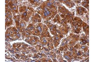 IHC-P Image Immunohistochemical analysis of paraffin-embedded human hepatoma, using mtRNA polymerase, antibody at 1:500 dilution.