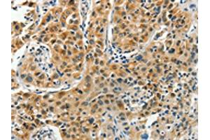 The image on the left is immunohistochemistry of paraffin-embedded Human lung cancer tissue using ABIN7191847(PFDN6 Antibody) at dilution 1/35, on the right is treated with synthetic peptide. (PFDN6 Antikörper)