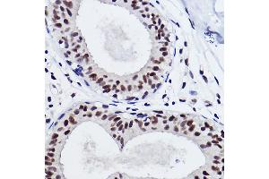 Immunohistochemistry of paraffin-embedded human breast cancer using SNRP Rabbit mAb (ABIN7270365) at dilution of 1:100 (40x lens). (SNRPA1 Antikörper)