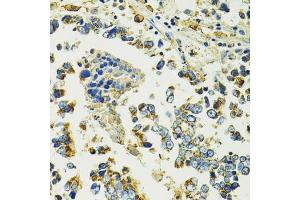 Immunohistochemistry of paraffin-embedded human colon carcinoma using SLC25 antibody (ABIN6132660, ABIN6147903, ABIN6147904 and ABIN6224187) at dilution of 1:100 (40x lens). (SLC25A11 Antikörper  (AA 1-314))