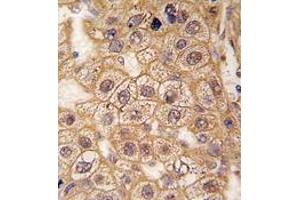Formalin-fixed and paraffin-embedded human hepatocarcinoma tissue reacted with BAR2 Antibody , which was peroxidase-conjugated to the secondary antibody, followed by DAB staining. (beta 2 Adrenergic Receptor Antikörper  (Ser261))