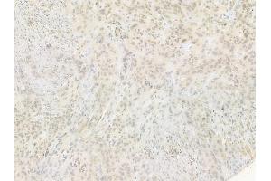 ABIN6255118 and ABIN6267547 at 1/100 staining human tongue carcinoma by IHC-P. (VASP Antikörper  (pSer239))