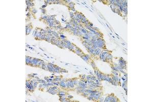 Immunohistochemistry of paraffin-embedded human colon carcinoma using CYP1A1 antibody (ABIN5971186) at dilution of 1/100 (40x lens). (CYP1A1 Antikörper)