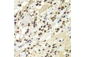 Immunohistochemistry of paraffin-embedded human kidney cancer using PRKDC antibody at dilution of 1:100 (x400 lens). (PRKDC Antikörper)