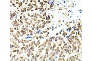 Immunohistochemistry of paraffin-embedded Human lung cancer using PNKP Polyclonal Antibody at dilution of 1:100 (40x lens). (PNKP Antikörper)