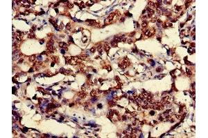 Immunohistochemistry of paraffin-embedded human gastric cancer using ABIN7149162 at dilution of 1:100 (COX IV Antikörper  (Isoform 1))