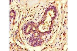 Immunohistochemistry of paraffin-embedded human breast cancer using ABIN7155525 at dilution of 1:100 (SUV39H1 Antikörper  (AA 179-412))