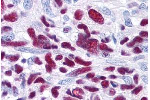 Glioblastoma (GLI3 Antikörper  (AA 41-57))