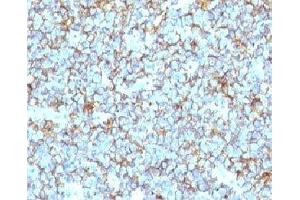Formalin-fixed, paraffin-embedded human Ewing's sarcoma stained with CD99 antibody (MIC2/877). (CD99 Antikörper)