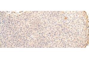 Immunohistochemistry of paraffin-embedded Human cervical cancer tissue using ZNF263 Polyclonal Antibody at dilution of 1:30(x200) (ZNF263 Antikörper)